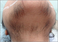 hairremoval-2