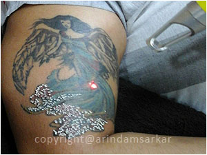 tattooremoval-1